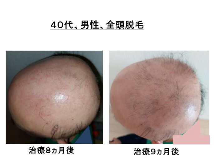 円形脱毛症　病院